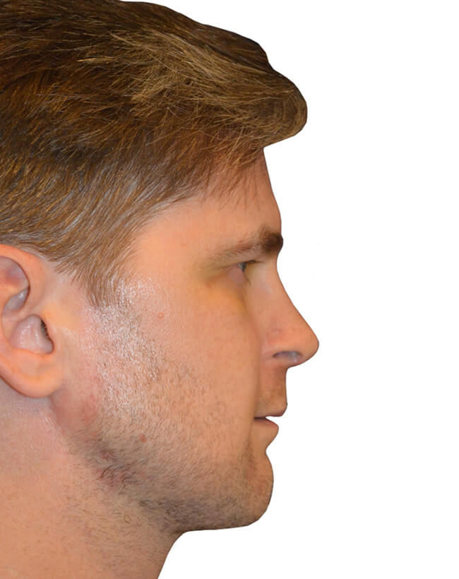 Patient After Chin Augmentation - Right Profile