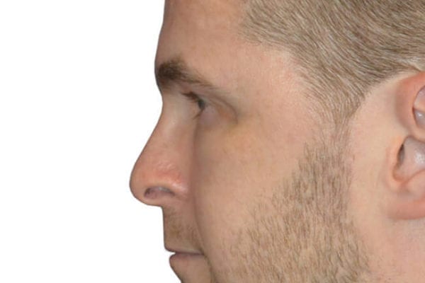 Chin Augmentation Patient 09 - Before - 1 Carousel Thumbnail