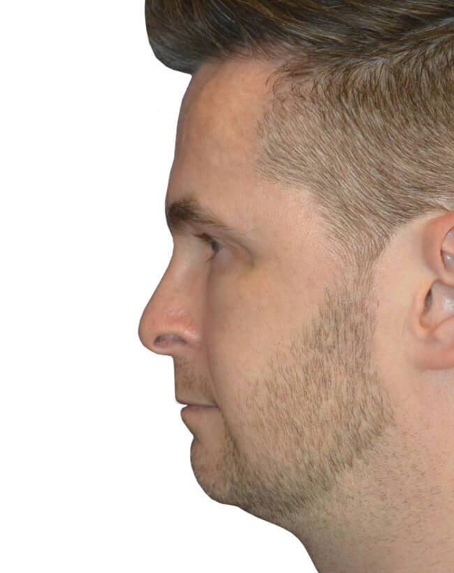 Patient Before Chin Augmentation