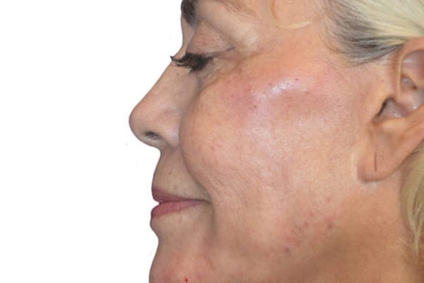 The Diamond Facial Sculpting Patient 01 - After - 1 Carousel Thumbnail