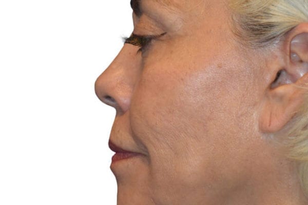 The Diamond Facial Sculpting Patient 01 - Before - 1 Carousel Thumbnail