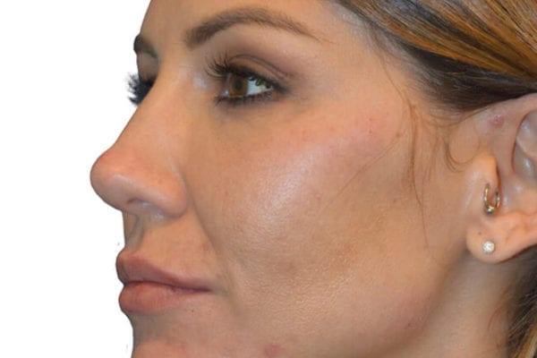 The Diamond Facial Sculpting Patient 10 - After - 1 Carousel Thumbnail