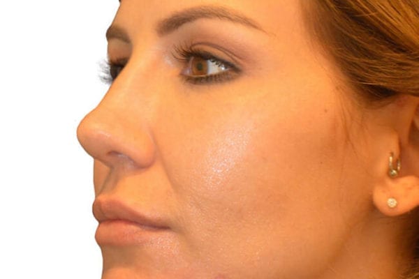 The Diamond Facial Sculpting Patient 10 - Before - 1 Carousel Thumbnail