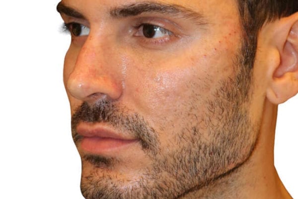 The Diamond Facial Sculpting Patient 11 - After - 1 Carousel Thumbnail