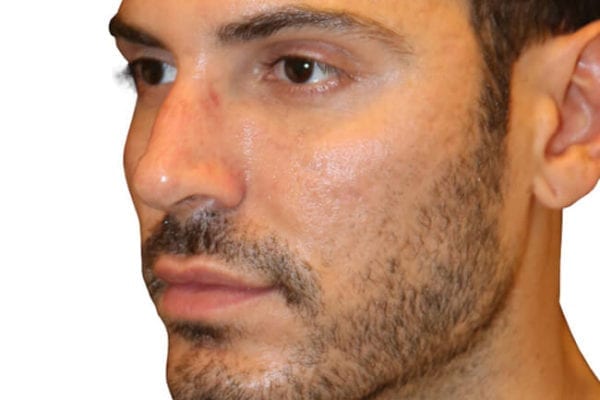 The Diamond Facial Sculpting Patient 11 - Before - 1 Carousel Thumbnail