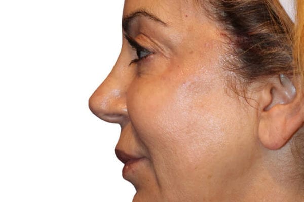 The Diamond Facial Sculpting Patient 12 - After - 1 Carousel Thumbnail