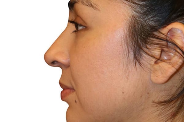 The Diamond Facial Sculpting Patient 02 - After - 1 Carousel Thumbnail