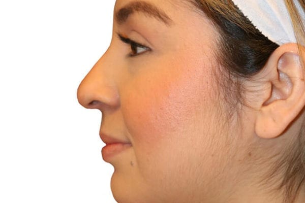 The Diamond Facial Sculpting Patient 02 - Before - 1 Carousel Thumbnail