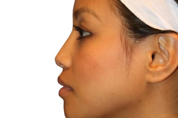 The Diamond Facial Sculpting Patient 03 - After - 1 Carousel Thumbnail