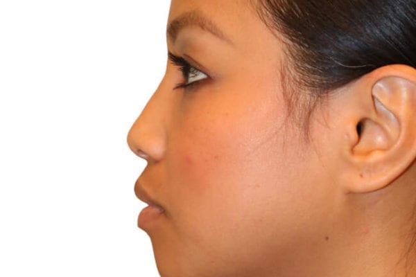 The Diamond Facial Sculpting Patient 03 - Before - 1 Carousel Thumbnail