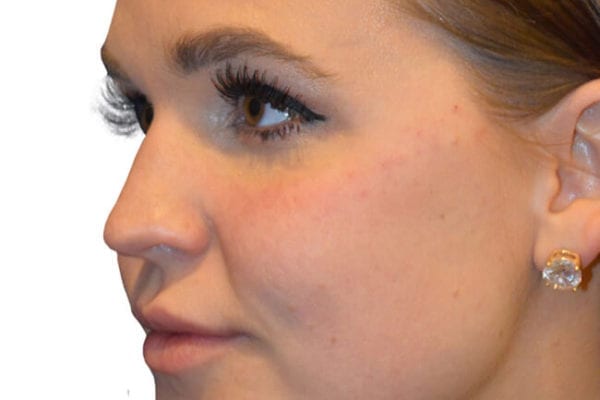 The Diamond Facial Sculpting Patient 04 - After - 1 Carousel Thumbnail