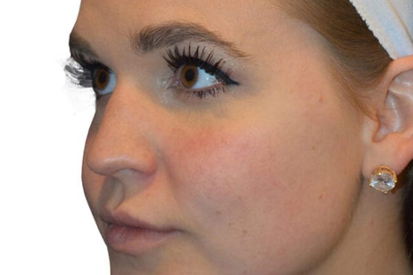 The Diamond Facial Sculpting Patient 04 - Before - 1 Carousel Thumbnail