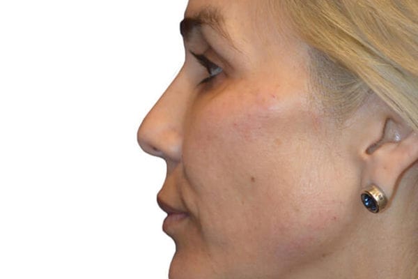 The Diamond Facial Sculpting Patient 05 - After - 1 Carousel Thumbnail