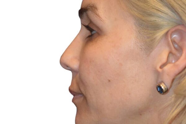 The Diamond Facial Sculpting Patient 05 - Before - 1 Carousel Thumbnail