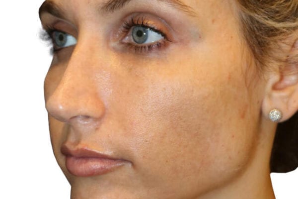 The Diamond Facial Sculpting Patient 06 - After - 1 Carousel Thumbnail