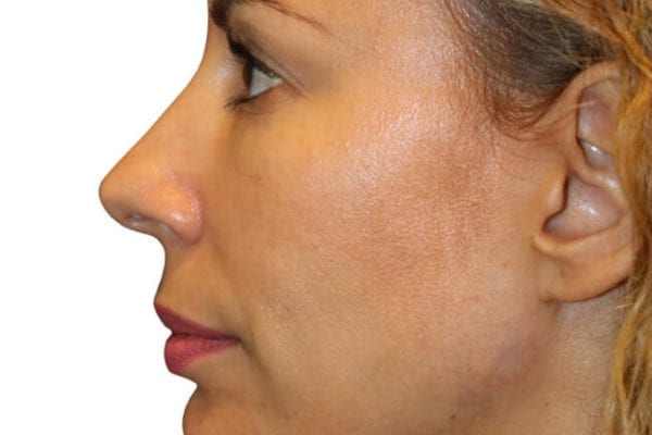 The Diamond Facial Sculpting Patient 07 - After - 1 Carousel Thumbnail