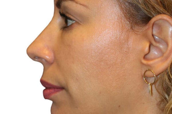 The Diamond Facial Sculpting Patient 07 - Before - 1 Carousel Thumbnail