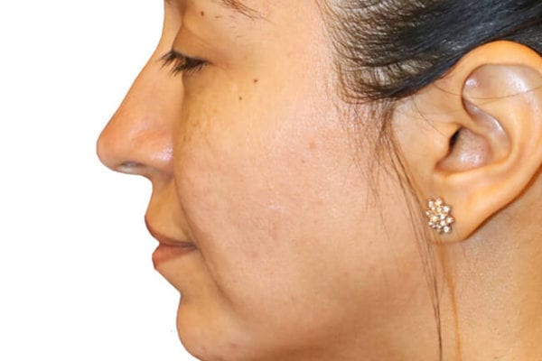 The Diamond Facial Sculpting Patient 08 - After - 1 Carousel Thumbnail