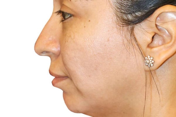 The Diamond Facial Sculpting Patient 08 - Before - 1 Carousel Thumbnail