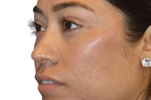 The Diamond Facial Sculpting Patient 09 - After - 1 Carousel Thumbnail