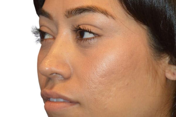 The Diamond Facial Sculpting Patient 09 - Before - 1 Carousel Thumbnail