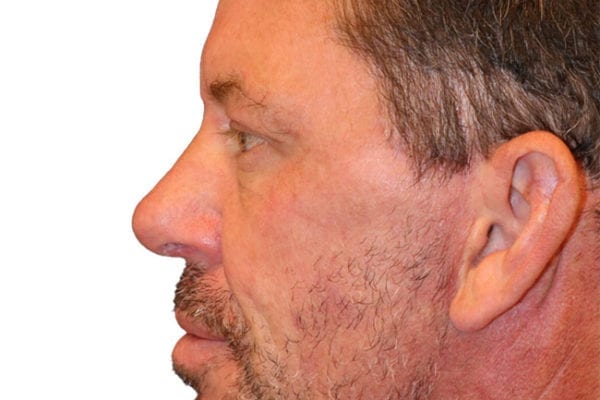 Neck Lift Patient 13 - After - 1 Carousel Thumbnail