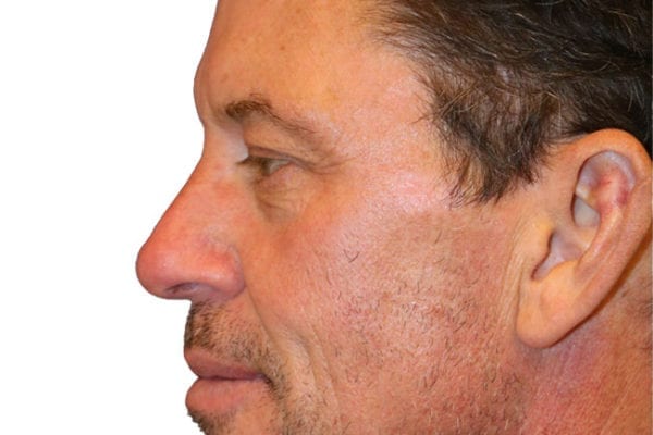Neck Lift Patient 13 - Before - 1 Carousel Thumbnail