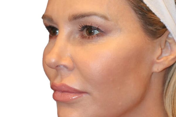 The Diamond Facial Sculpting Patient 19 - After - 1 Carousel Thumbnail