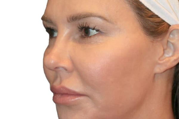 The Diamond Facial Sculpting Patient 19 - Before - 1 Carousel Thumbnail