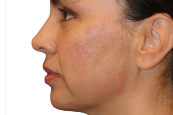 The Diamond Facial Sculpting Patient 21 - After - 1 Carousel Thumbnail