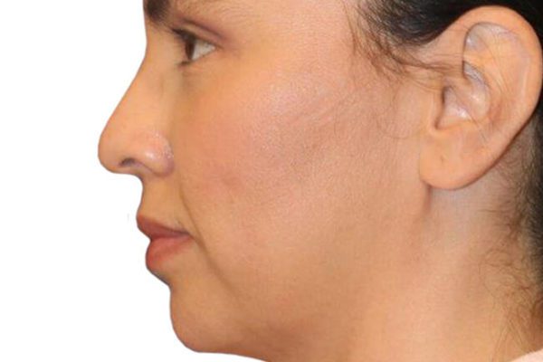The Diamond Facial Sculpting Patient 21 - Before - 1 Carousel Thumbnail