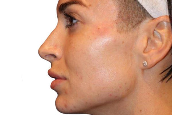 The Diamond Facial Sculpting Patient 22 - After - 1 Carousel Thumbnail