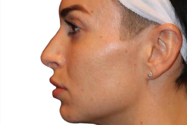 The Diamond Facial Sculpting Patient 22 - Before - 1 Carousel Thumbnail