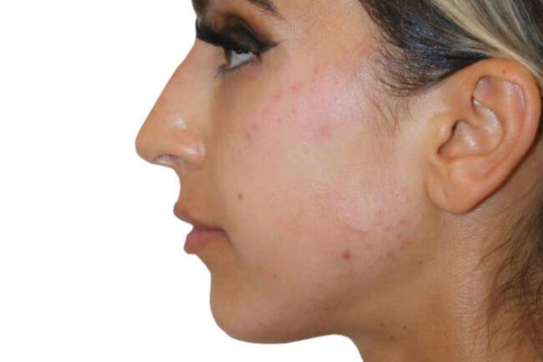 The Diamond Facial Sculpting Patient 23 - After - 1 Carousel Thumbnail