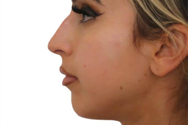 The Diamond Facial Sculpting Patient 23 - Before - 1 Carousel Thumbnail