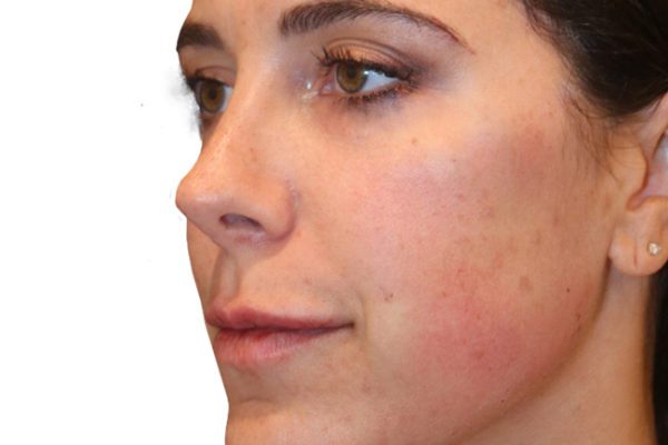 The Diamond Facial Sculpting Patient 24 - After - 1 Carousel Thumbnail