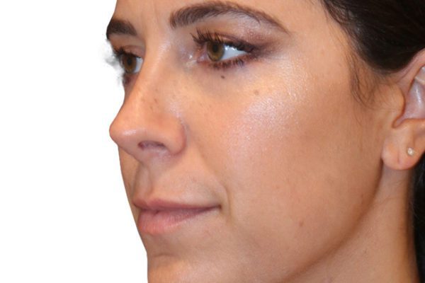 The Diamond Facial Sculpting Patient 24 - Before - 1 Carousel Thumbnail