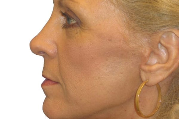 Eyelid Surgery Patient 01 - After - 1 Carousel Thumbnail