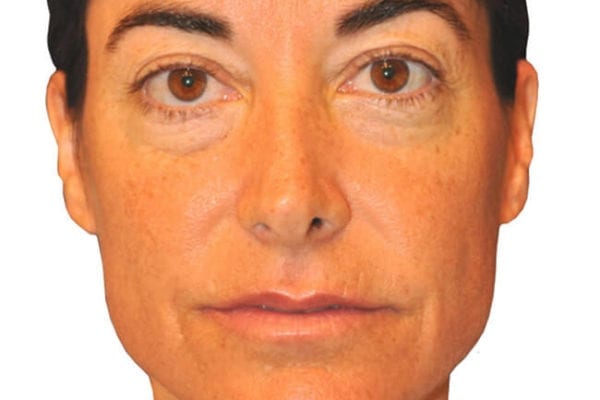 Eyelid Surgery Patient 02 - Before - 1 Carousel Thumbnail