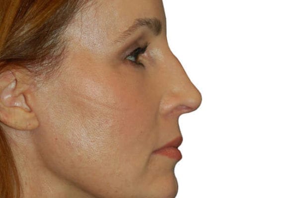 Eyelid Surgery Patient 03 - After - 1 Carousel Thumbnail