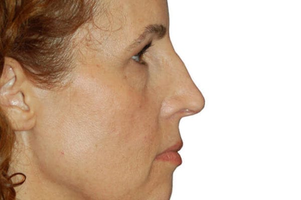 Eyelid Surgery Patient 03 - Before - 1 Carousel Thumbnail