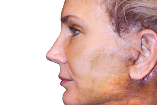 Neck Lift Patient 15 - After - 1 Carousel Thumbnail