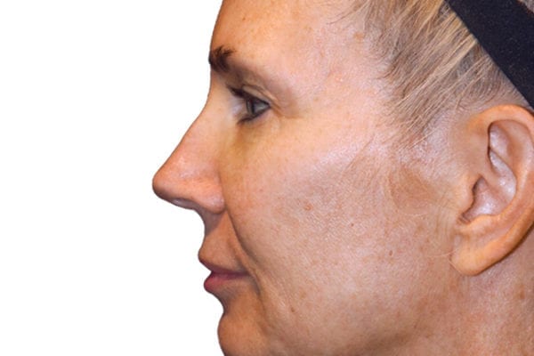 Neck Lift Patient 15 - Before - 1 Carousel Thumbnail