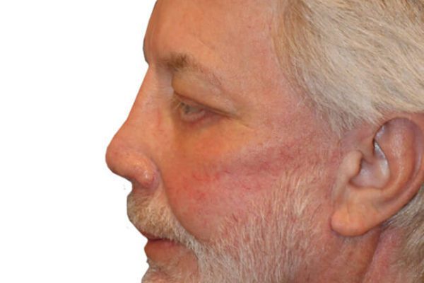 Facelift Patient 19 - After - 1 Carousel Thumbnail