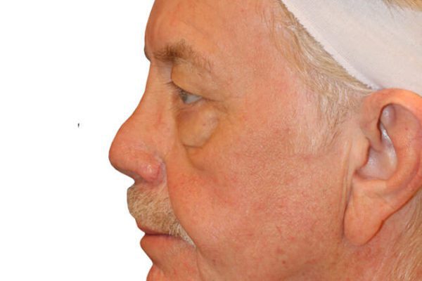 Facelift Patient 19 - Before - 1 Carousel Thumbnail