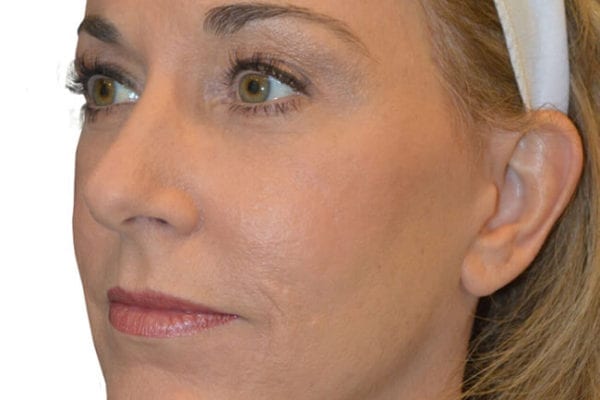 Facelift Patient 10 - After - 1 Carousel Thumbnail