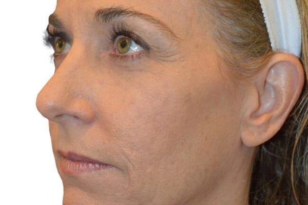 Facelift Patient 10 - Before - 1 Carousel Thumbnail