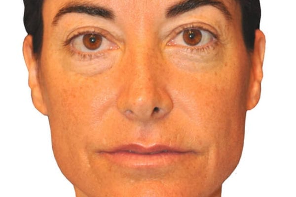 Facelift Patient 11 - Before - 1 Carousel Thumbnail