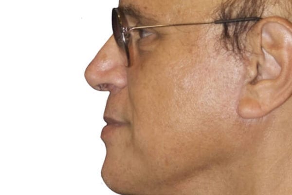 Facelift Patient 12 - After - 1 Carousel Thumbnail