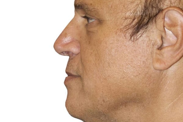 Facelift Patient 12 - Before - 1 Carousel Thumbnail